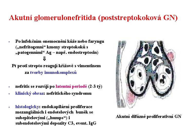 Akutní glomerulonefritida (poststreptokoková GN) § § Po infekčním onemocnění kůže nebo faryngu („nefritogenní“ kmeny