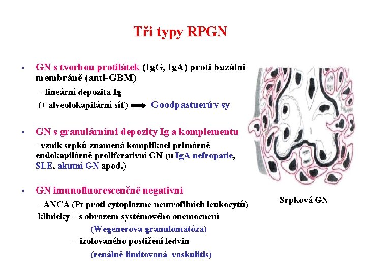 Tři typy RPGN § GN s tvorbou protilátek (Ig. G, Ig. A) proti bazální
