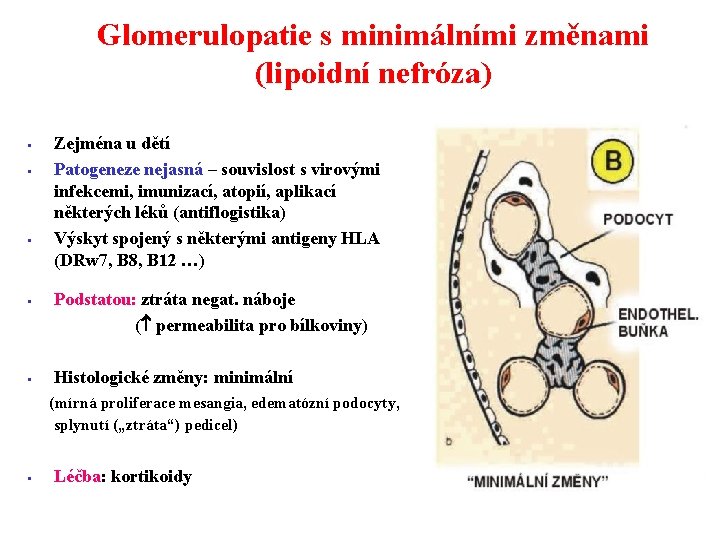 Glomerulopatie s minimálními změnami (lipoidní nefróza) § § § Zejména u dětí Patogeneze nejasná