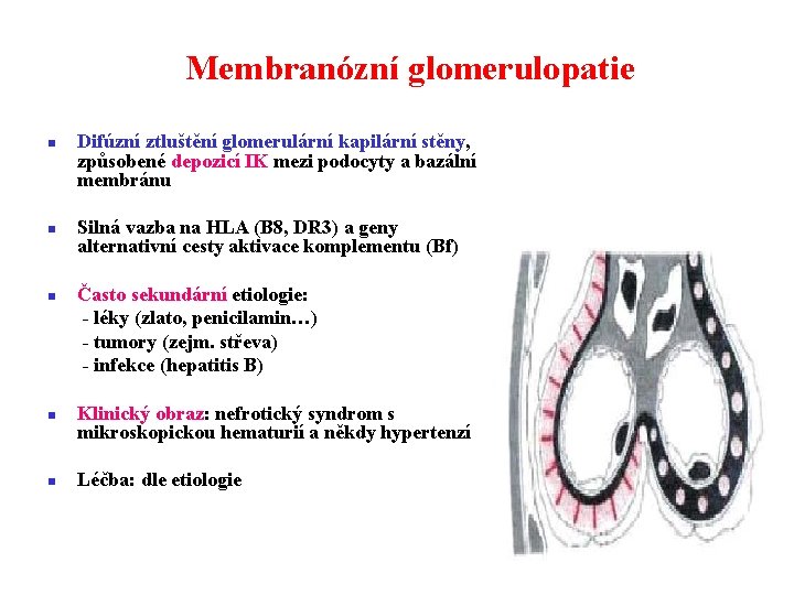 Membranózní glomerulopatie n n n Difúzní ztluštění glomerulární kapilární stěny, způsobené depozicí IK mezi