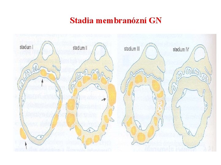 Stadia membranózní GN 