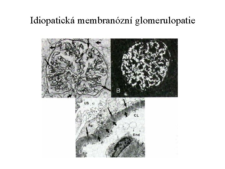 Idiopatická membranózní glomerulopatie 