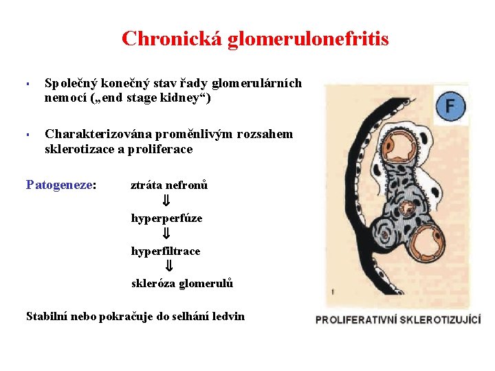 Chronická glomerulonefritis § § Společný konečný stav řady glomerulárních nemocí („end stage kidney“) Charakterizována