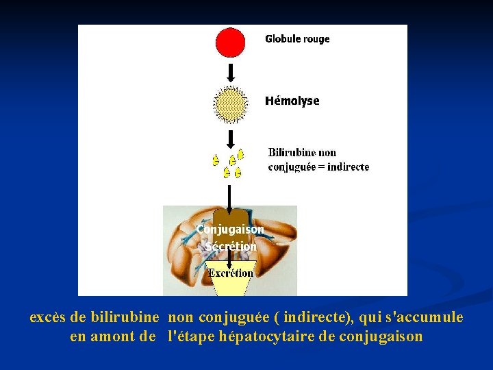  excès de bilirubine non conjuguée ( indirecte), qui s'accumule en amont de l'étape