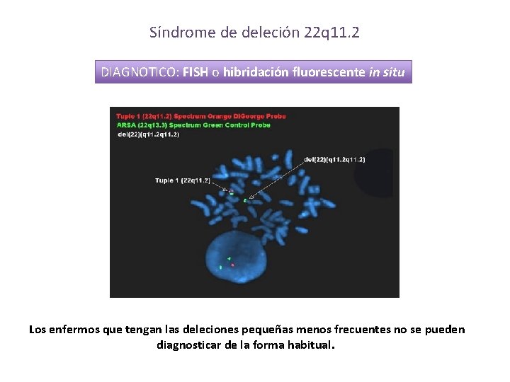 Síndrome de deleción 22 q 11. 2 DIAGNOTICO: FISH o hibridación fluorescente in situ