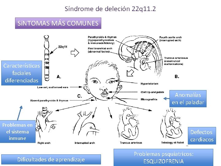 Síndrome de deleción 22 q 11. 2 SíNTOMAS MÁS COMUNES Características faciales diferenciadas Anomalías