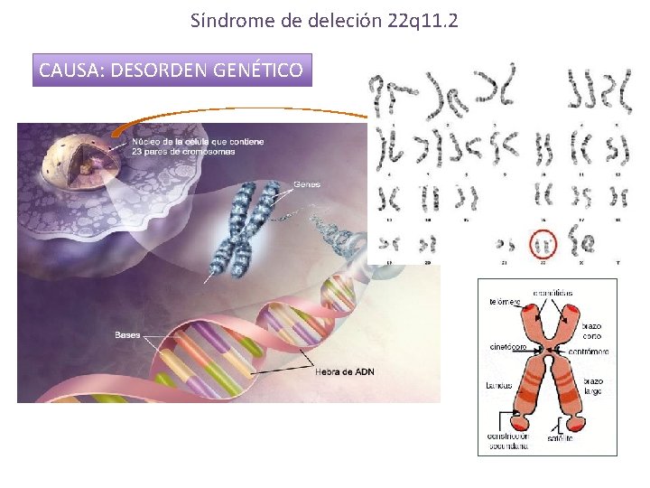 Síndrome de deleción 22 q 11. 2 CAUSA: DESORDEN GENÉTICO 