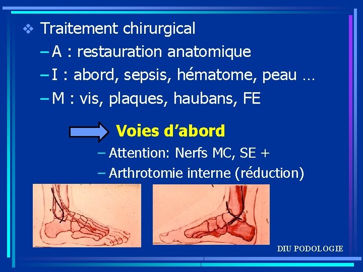 v Traitement chirurgical – A : restauration anatomique – I : abord, sepsis, hématome,