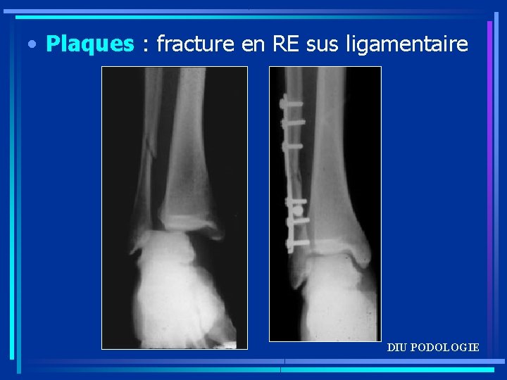  • Plaques : fracture en RE sus ligamentaire DIU PODOLOGIE 