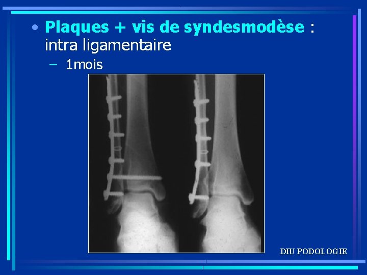  • Plaques + vis de syndesmodèse : intra ligamentaire – 1 mois DIU