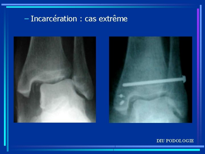 – Incarcération : cas extrême DIU PODOLOGIE 