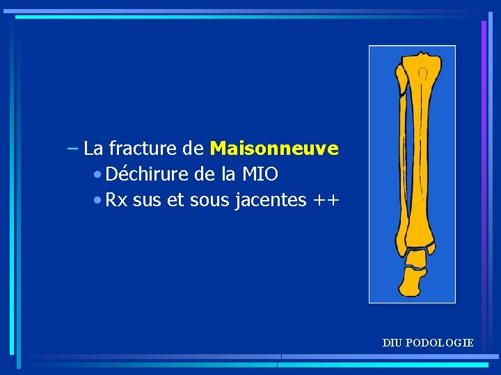 – La fracture de Maisonneuve • Déchirure de la MIO • Rx sus et