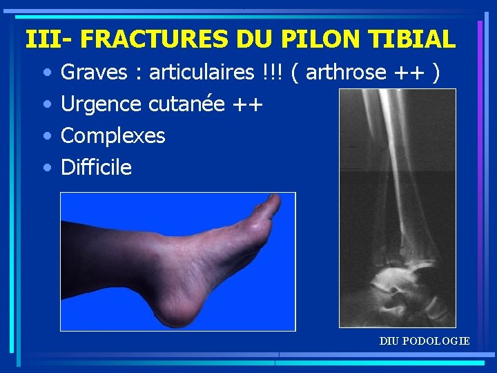 III- FRACTURES DU PILON TIBIAL • • Graves : articulaires !!! ( arthrose ++