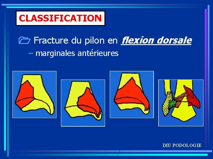 CLASSIFICATION Fracture du pilon en flexion dorsale – marginales antérieures DIU PODOLOGIE 