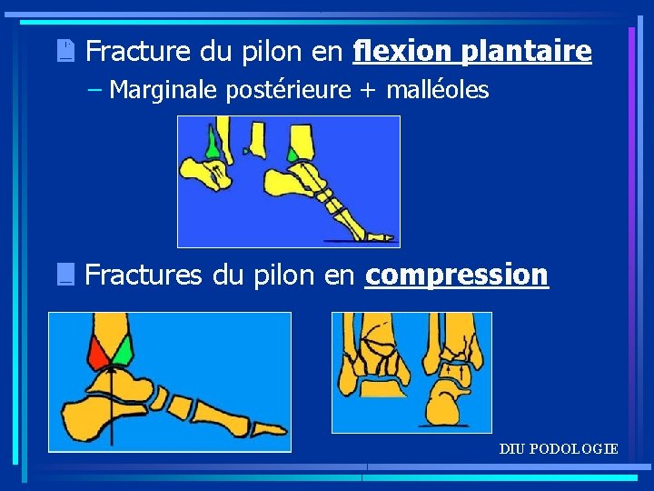  Fracture du pilon en flexion plantaire – Marginale postérieure + malléoles Fractures du