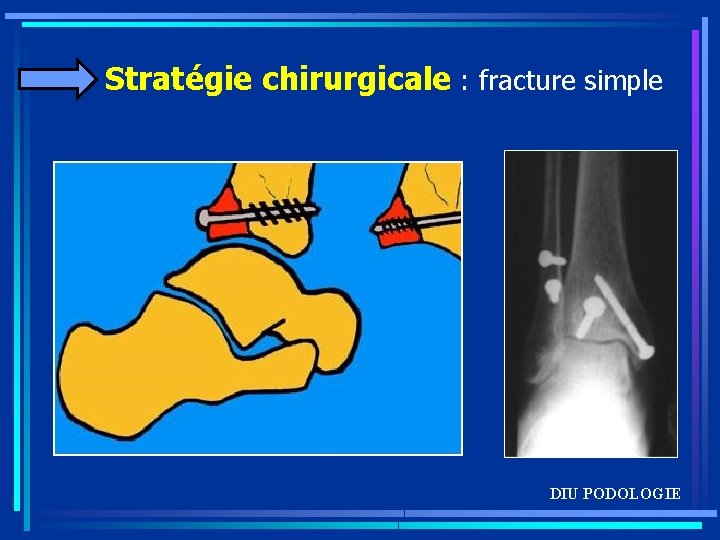 Stratégie chirurgicale : fracture simple DIU PODOLOGIE 