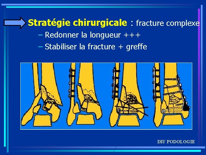 Stratégie chirurgicale : fracture complexe – Redonner la longueur +++ – Stabiliser la fracture