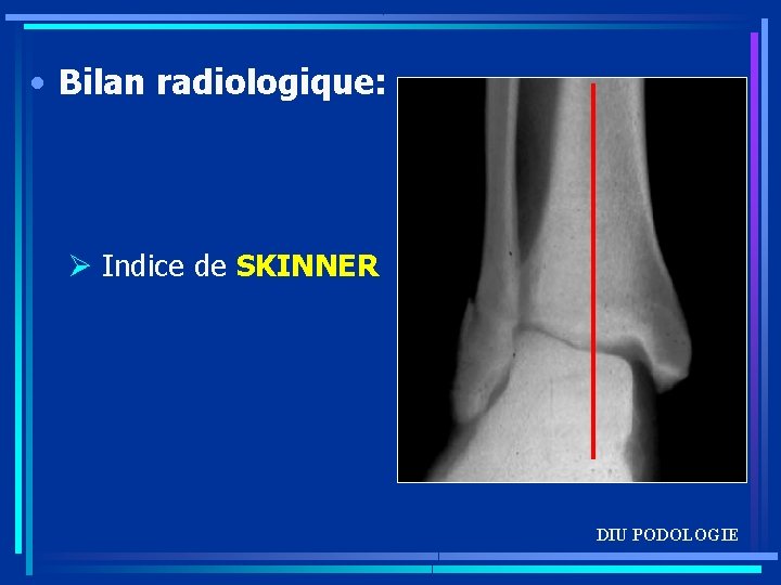  • Bilan radiologique: Ø Indice de SKINNER DIU PODOLOGIE 