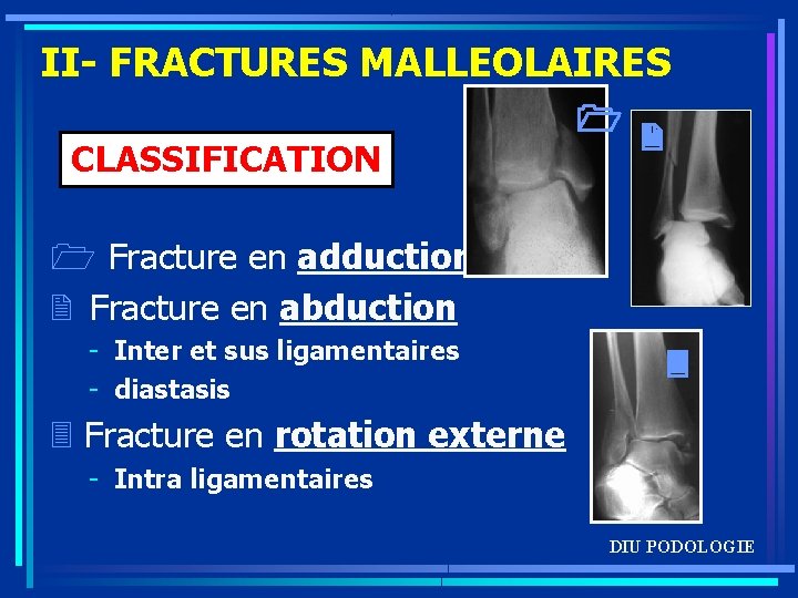 II- FRACTURES MALLEOLAIRES CLASSIFICATION 1 Fracture en adduction 2 Fracture en abduction - Inter