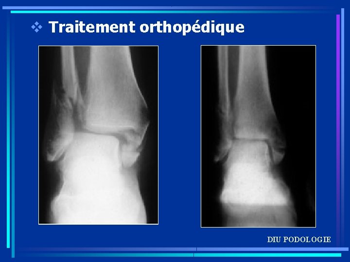 v Traitement orthopédique DIU PODOLOGIE 
