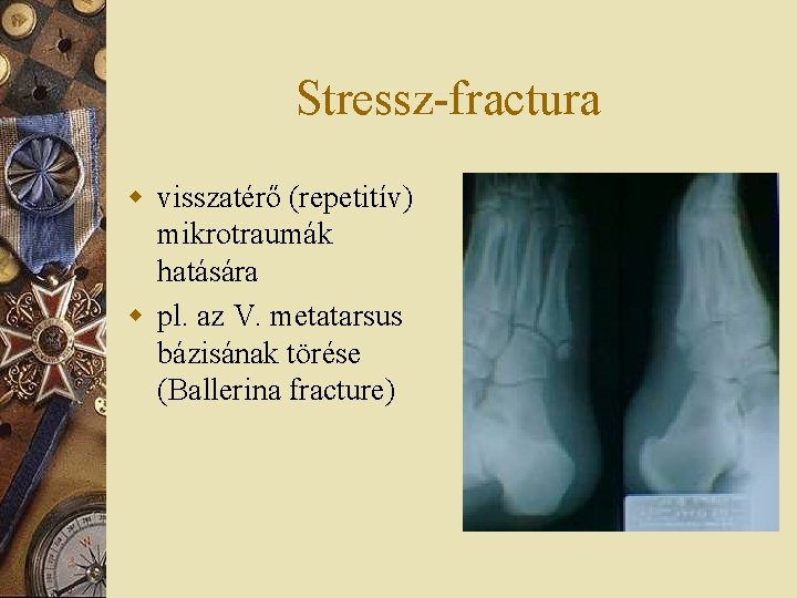 Stressz-fractura w visszatérő (repetitív) mikrotraumák hatására w pl. az V. metatarsus bázisának törése (Ballerina