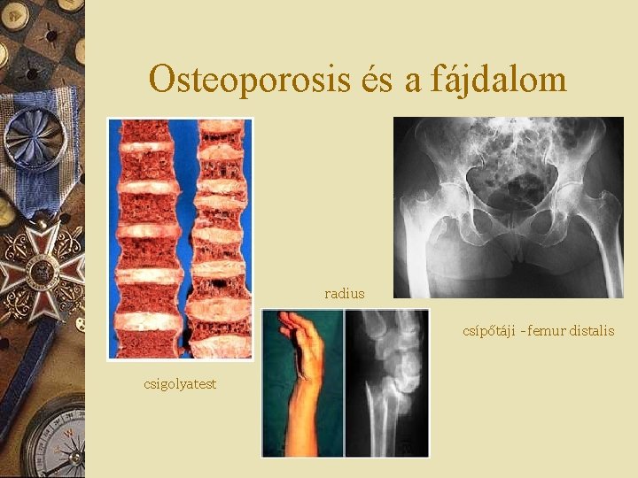Osteoporosis és a fájdalom radius csípőtáji - femur distalis csigolyatest 