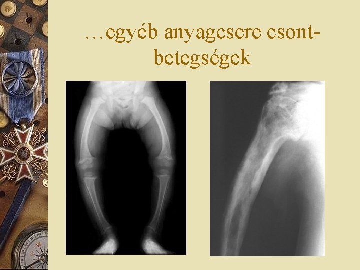 …egyéb anyagcsere csontbetegségek 