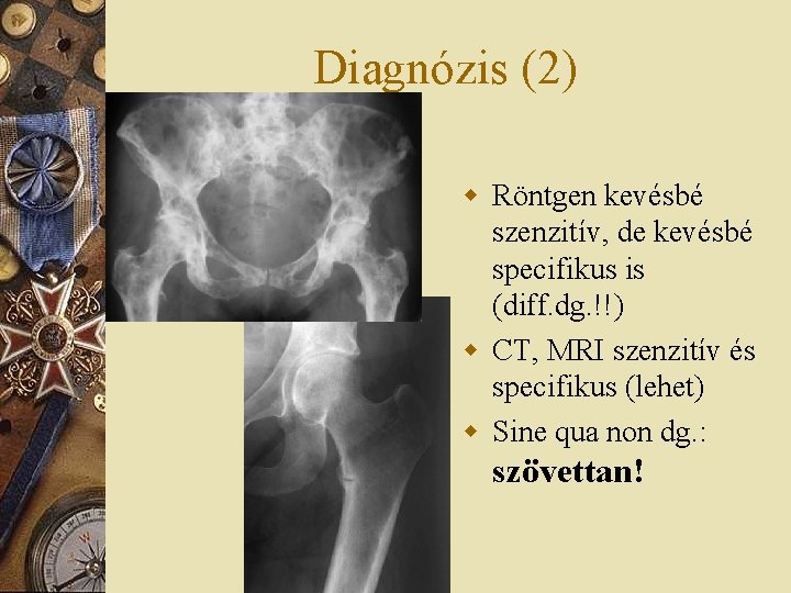 Diagnózis (2) w Röntgen kevésbé szenzitív, de kevésbé specifikus is (diff. dg. !!) w