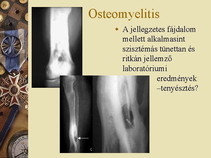 Osteomyelitis w A jellegzetes fájdalom mellett alkalmasint szisztémás tünettan és ritkán jellemző laboratóriumi eredmények