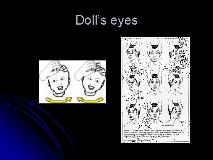 Doll’s eyes 