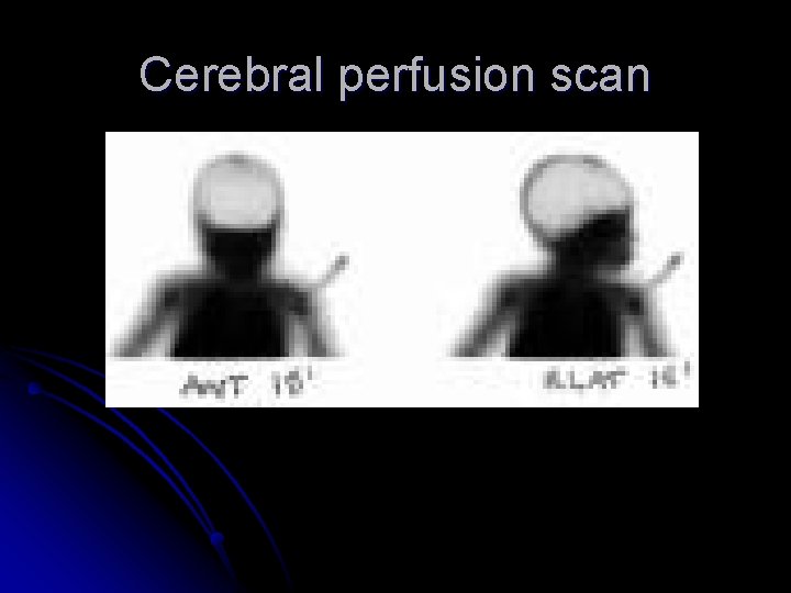 Cerebral perfusion scan 