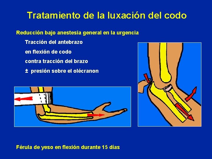 Tratamiento de la luxación del codo Reducción bajo anestesia general en la urgencia Tracción