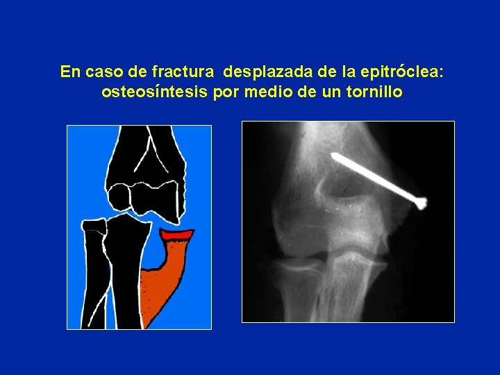 En caso de fractura desplazada de la epitróclea: osteosíntesis por medio de un tornillo