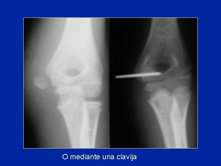 O mediante una clavija 