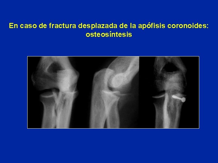 En caso de fractura desplazada de la apófisis coronoides: osteosíntesis 