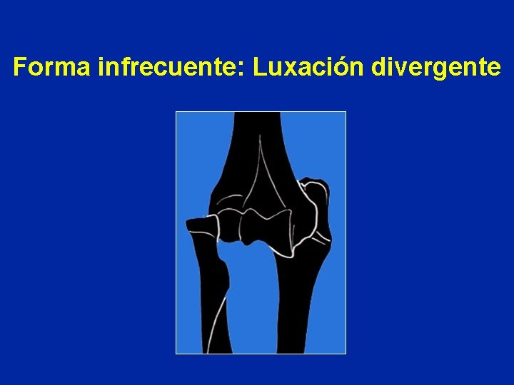 Forma infrecuente: Luxación divergente 