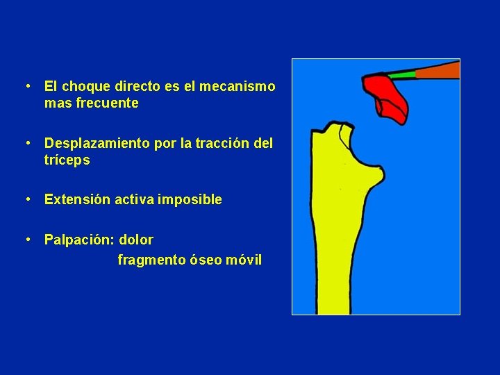  • El choque directo es el mecanismo mas frecuente • Desplazamiento por la