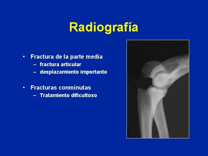 Radiografía • Fractura de la parte media – fractura articular – desplazamiento importante •