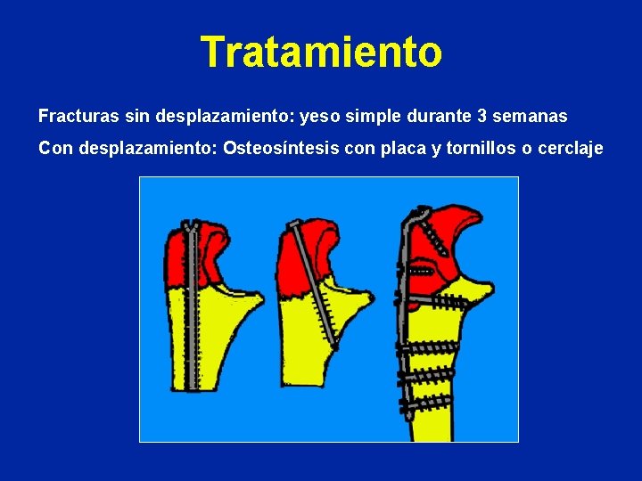 Tratamiento Fracturas sin desplazamiento: yeso simple durante 3 semanas Con desplazamiento: Osteosíntesis con placa