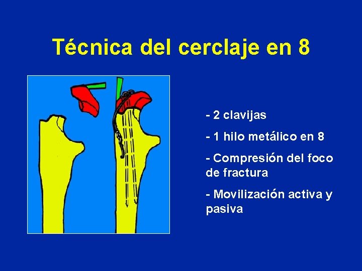 Técnica del cerclaje en 8 - 2 clavijas - 1 hilo metálico en 8