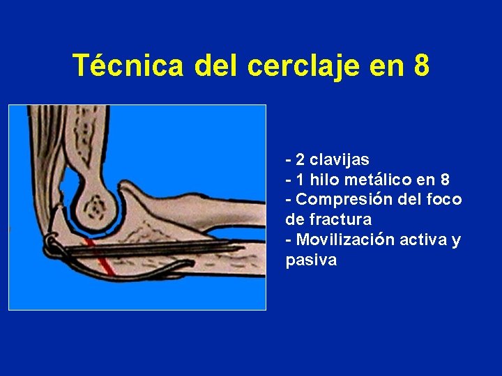 Técnica del cerclaje en 8 - 2 clavijas - 1 hilo metálico en 8