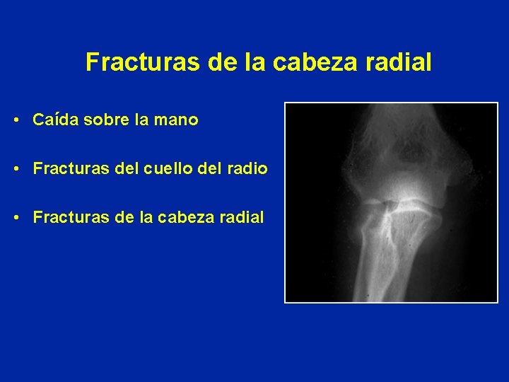 Fracturas de la cabeza radial • Caída sobre la mano • Fracturas del cuello