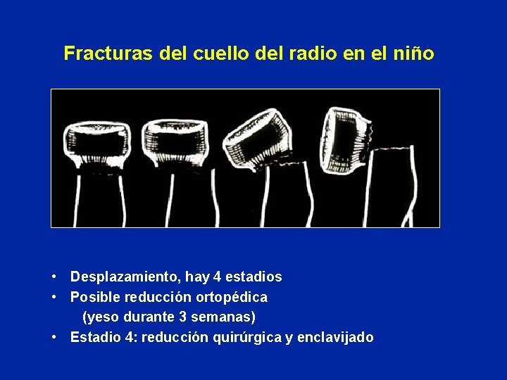 Fracturas del cuello del radio en el niño • Desplazamiento, hay 4 estadios •