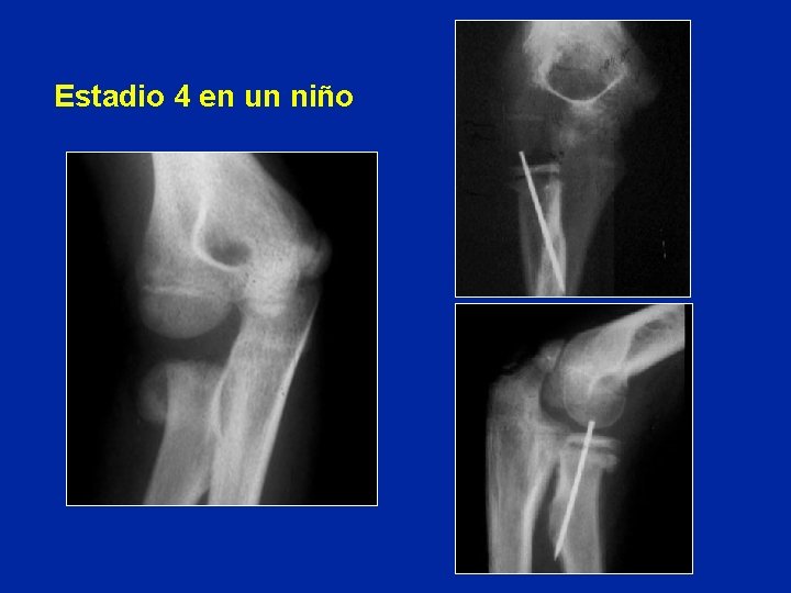 Estadio 4 en un niño 