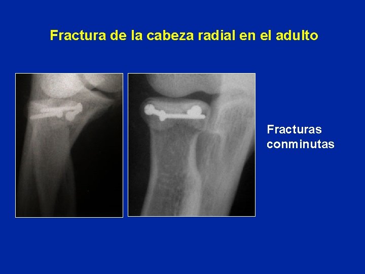 Fractura de la cabeza radial en el adulto Fracturas conminutas 