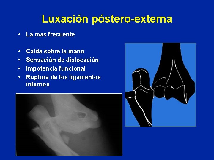 Luxación póstero-externa • La mas frecuente • • Caída sobre la mano Sensación de