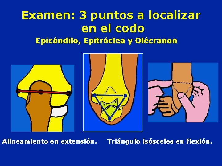 Examen: 3 puntos a localizar en el codo Epicóndilo, Epitróclea y Olécranon Alineamiento en