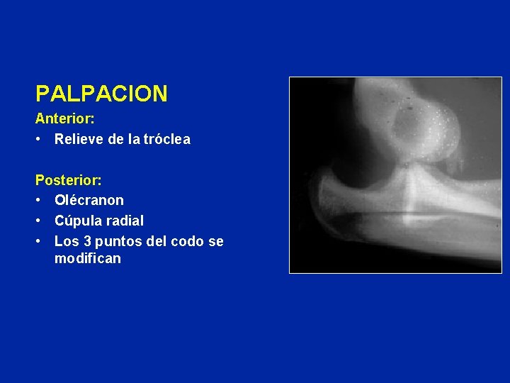 PALPACION Anterior: • Relieve de la tróclea Posterior: • Olécranon • Cúpula radial •