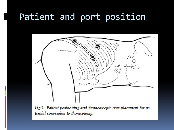 Patient and port position 