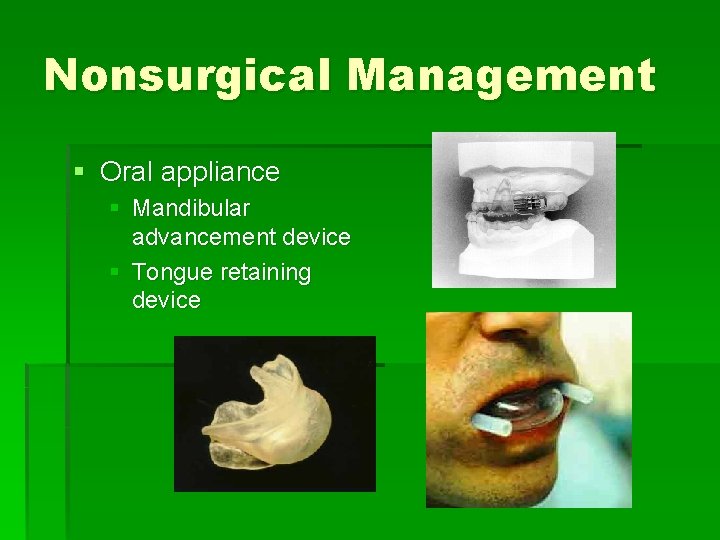 Nonsurgical Management § Oral appliance § Mandibular advancement device § Tongue retaining device 